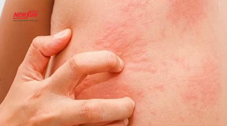 Tác dụng phụ của hạt mắc ca là gì? 4 nhóm người không nên ăn tác dụng phụ của hạt mắc ca, dị ứng