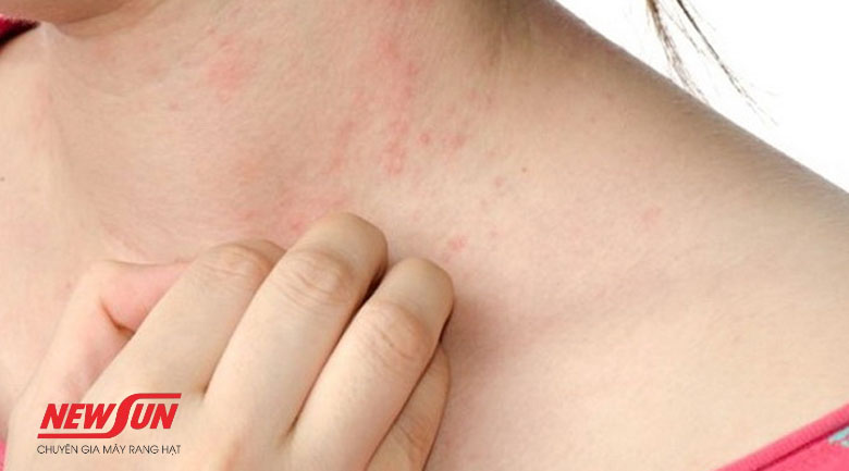 Lưu ngay 5 tác hại của hạt dẻ để tránh ảnh hưởng đến sức khỏe tác hại của hạt dẻ, dị ứng
